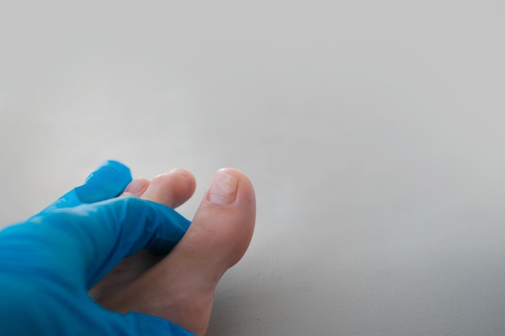 Cirurgia de Joanetes: o que você precisa saber antes
