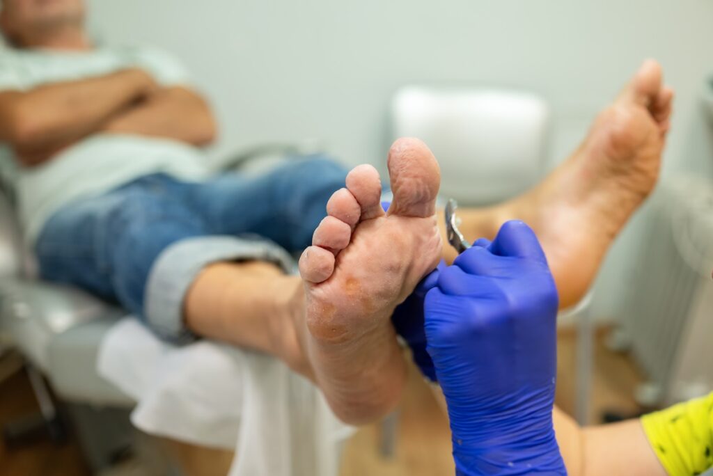 Cirurgia em pé diabético: precauções e procedimentos