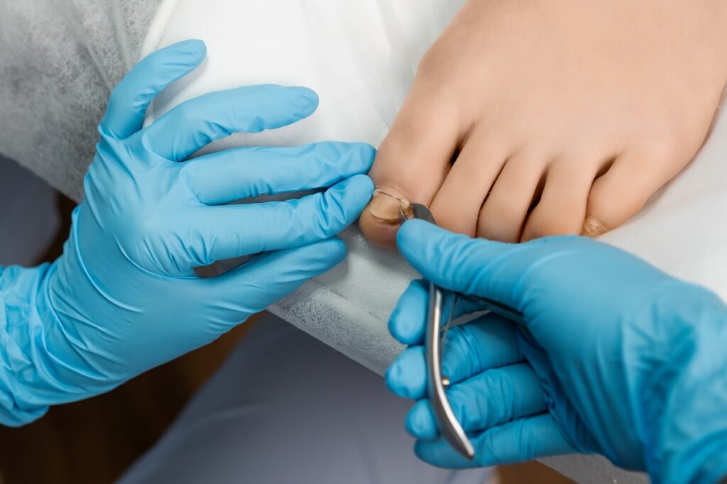 Cirurgia para Hálux Rigidus: o que esperar antes, durante e depois