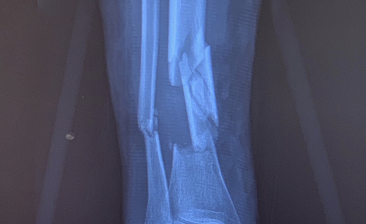 Fratura na fíbula distal: tempo de recuperação?