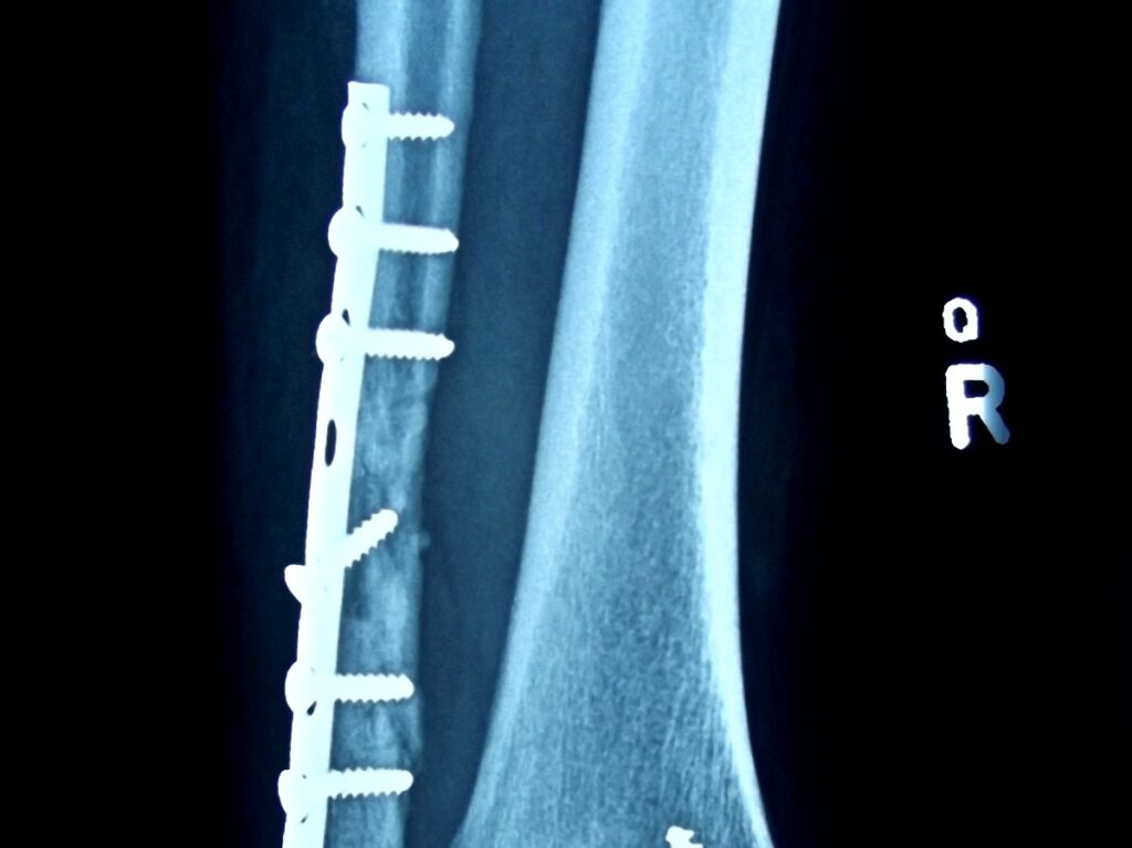 Fratura na fíbula distal: tempo de recuperação?