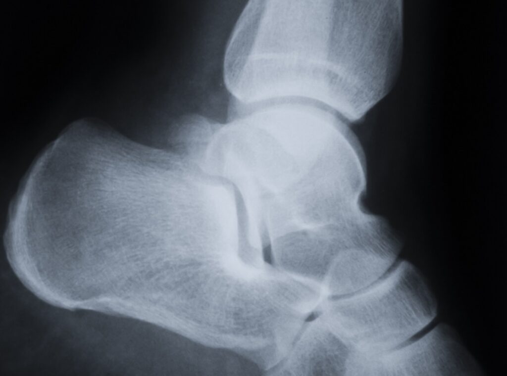 Fratura no maléolo medial e maléolo lateral: causas, diagnóstico e tratamento