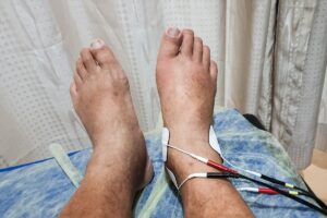 Lesão no tendão extensor longo dos dedos do pé