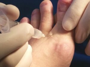 Qual o melhor tênis para quem tem neuroma de Morton?