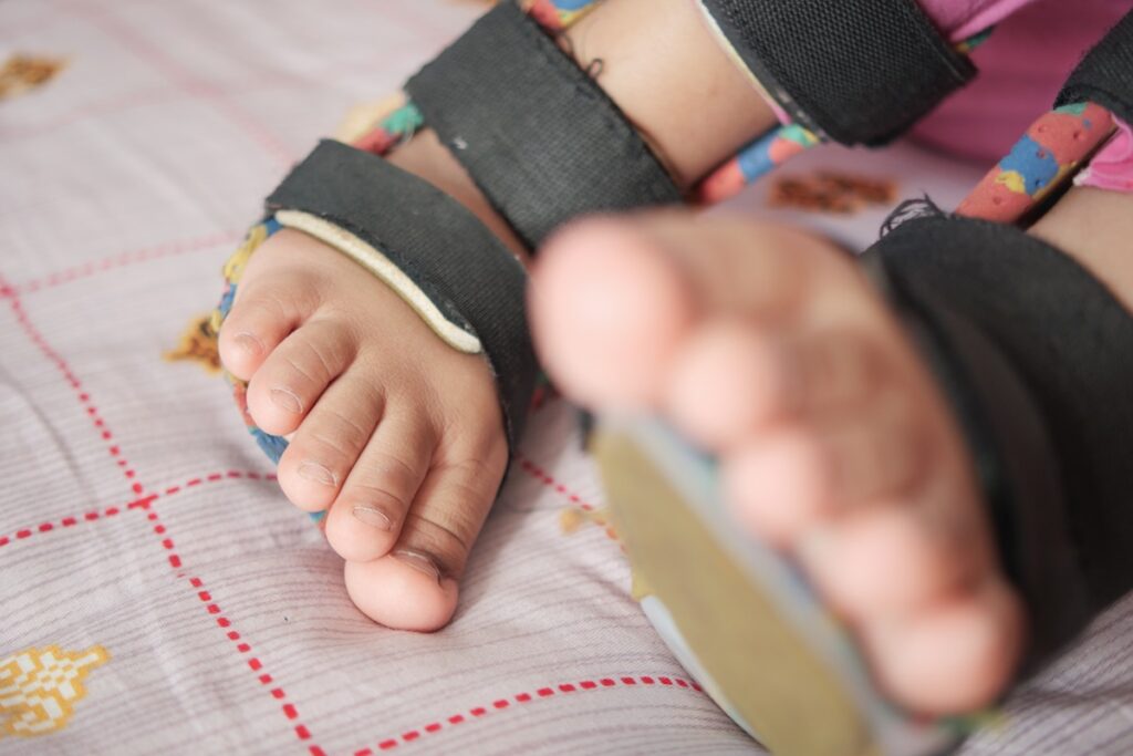 Tratamento Cirúrgico para Pé Torto: Etapas e Recuperação