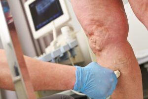 Dor no tornozelo após cirurgia de varizes: como evitá-la?