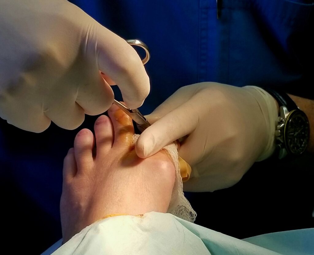 Cirurgia nos dedos dos pés: técnica, indicações e pós-operatório
