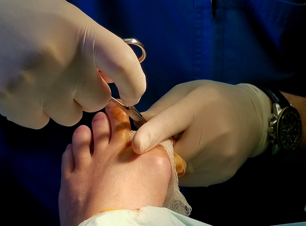 Cirurgia para diminuir o dedo do pé: como funciona?