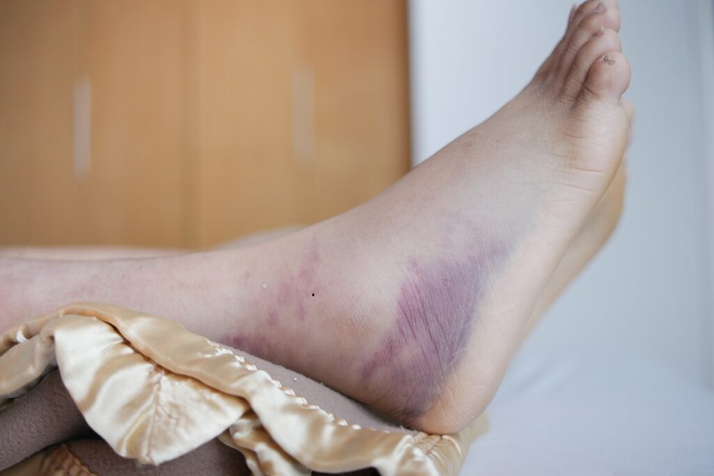 Como tratar e diminuir o edema no tornozelo: abordagens clínicas e cuidados essenciais