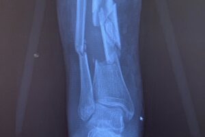 Tempo de recuperação após fratura de tornozelo e fíbula