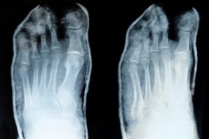 Fratura do Quinto Metatarso: Quando a Cirurgia é Necessária?