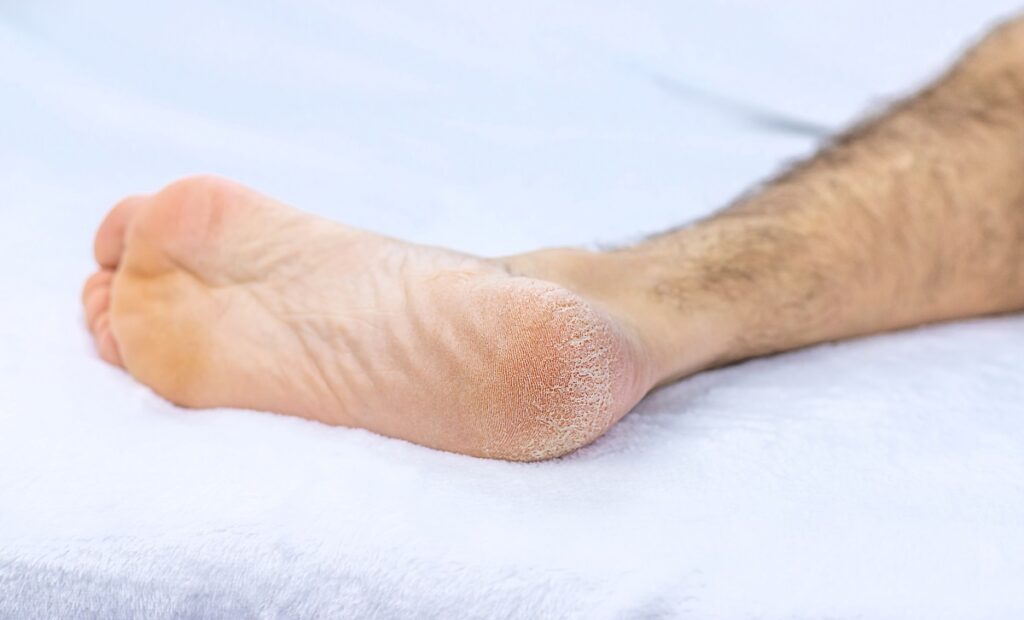 Romper Ligamento do Pé: Consequências e Tempo de Recuperação