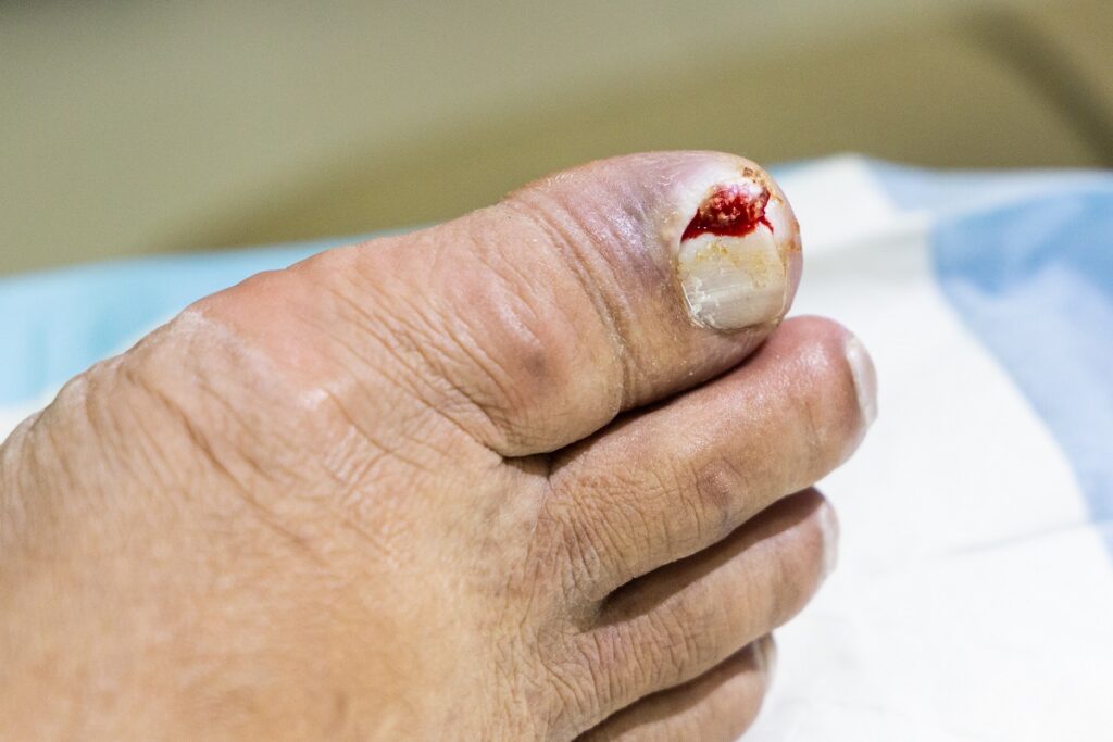 Machucado no dedo do pé: como acelerar a recuperação