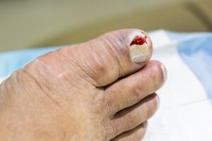 Machucado no dedo do pé: como acelerar a recuperação