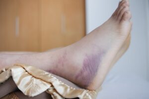 Manchas vermelhas no tornozelo: tipos de doenças e tratamentos - Dra ...