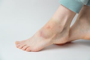 Manchas vermelhas no tornozelo: tipos de doenças e tratamentos