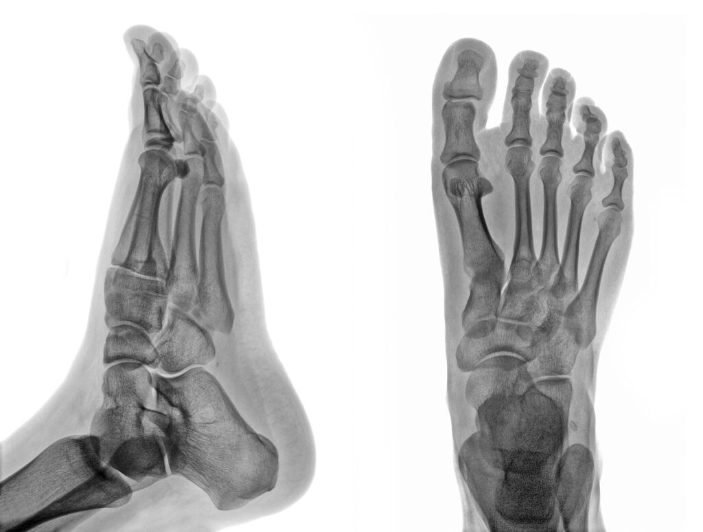 Por que sinto dor no osso navicular do pé?