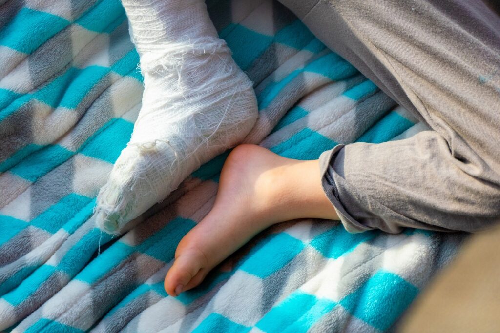 Pé quebrado: tempo de recuperação esperado