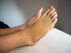 Tornozelo Inchado Após Queda: É Normal?